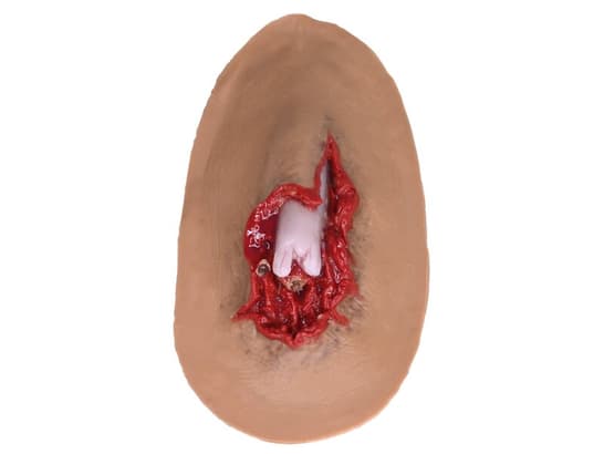 Compound Fracture - Laerdal Medium