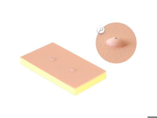 Sebaceous Cyst Pad