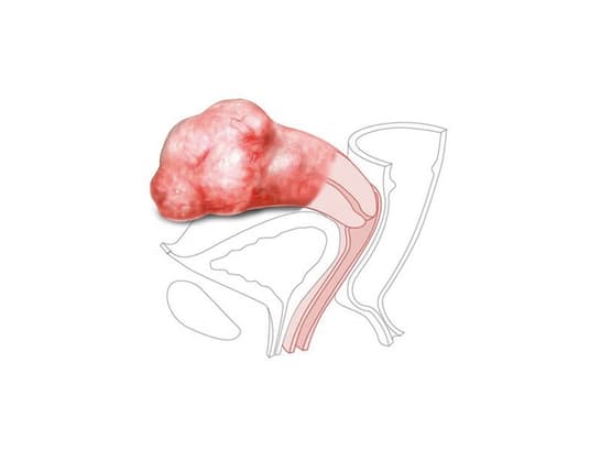 CFPT Mod 2:Large Fibroid Nulliparous Ectr. Cervix