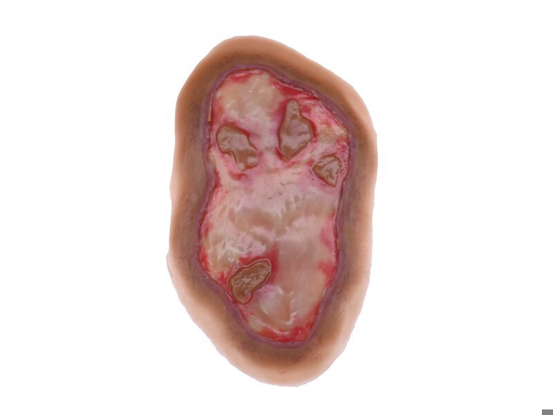 Chemical Burn - Laerdal Medium