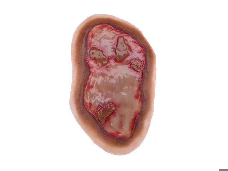 Chemical Burn - Laerdal Dark