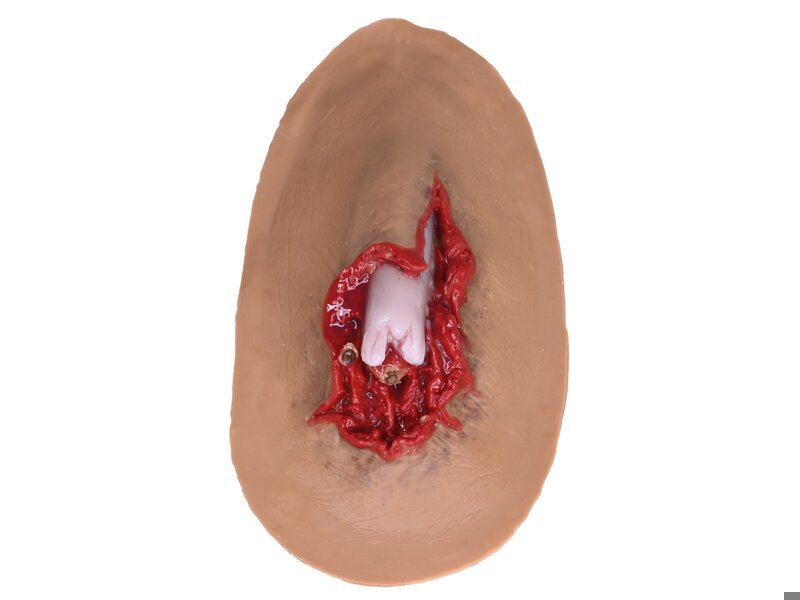 Compound Fracture - Laerdal Medium 