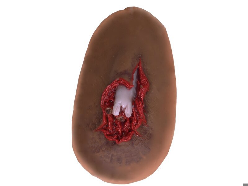 Compound Fracture - Laerdal Dark