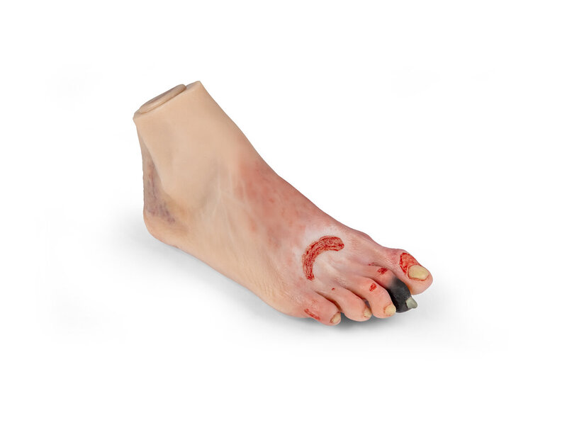 Foot Syndrome, Diabetic