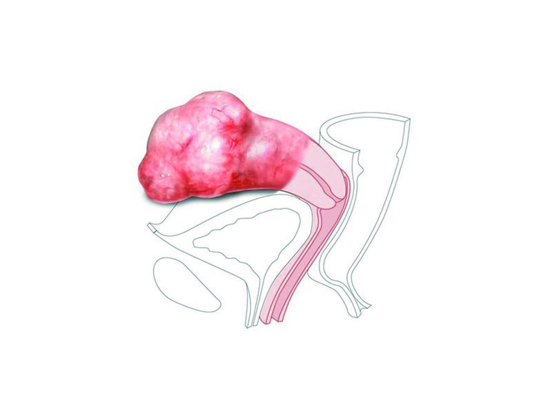 CFPT Mod 2:Large Fibroid Nulliparous Ectr. Cervix