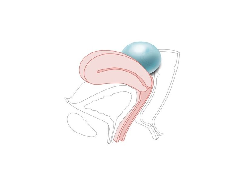 CFPT Mk 3 Module 4: Kyste de l'ovaire - Col de l'utérus multipare