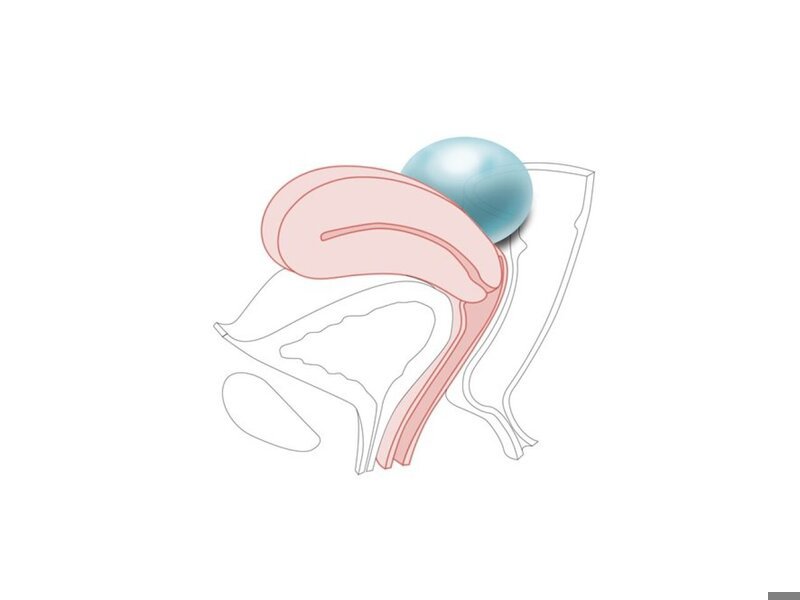 CFPT Mod 4:Ovarian Cyst Multiparous Cervix