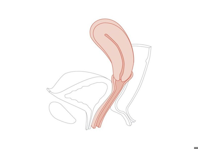 CFPT Mod 5:Retroverted Multiparous Cervix