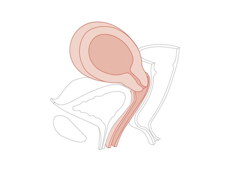 CFPT Mk 3 Module 6: 10-12 semaines - Col de l'utérus enceinte