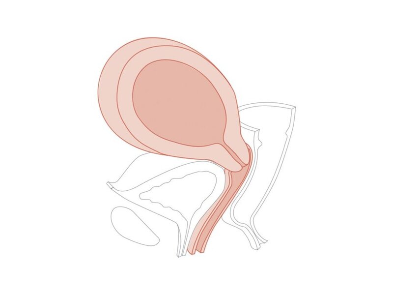 CFPT Mod 7:14-16 weeks Pregnant Cervix